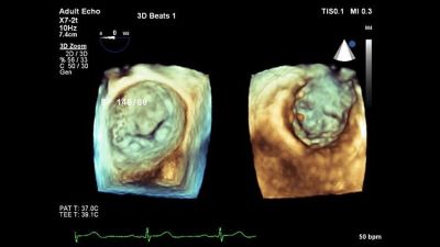 Philips EPIQ CVx