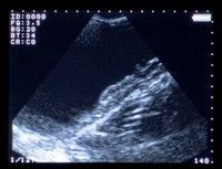 Acuvista VT98m
