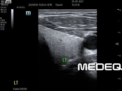 Mindray L14-6s