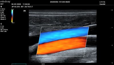 Mindray MX7 